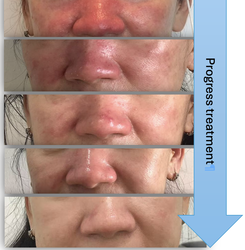 Kasus SLE (Lupus dengan kemerahan wajah)