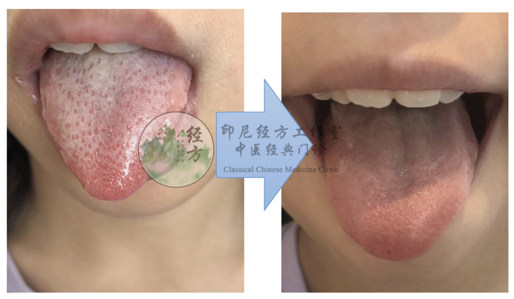 Sinshe ICCM menangani kasus demam anak dengan metode Jing Fang di Batam