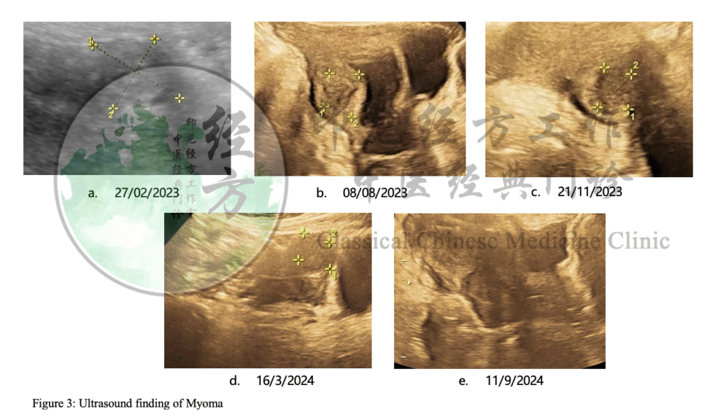 Hasil USG pasien menunjukkan pengecilan mioma uterus setelah pengobatan TCM di ICCM Batam oleh Sinshe Batam menggunakan metode Jing Fang