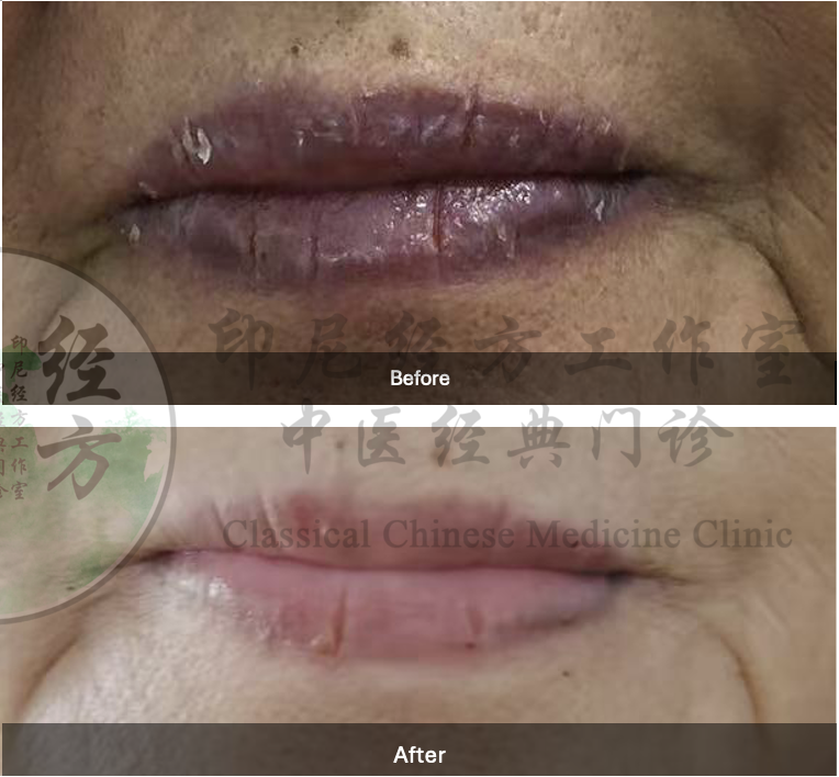 Hasil terapi TCM menunjukkan penurunan kemerahan dan peradangan bibir
