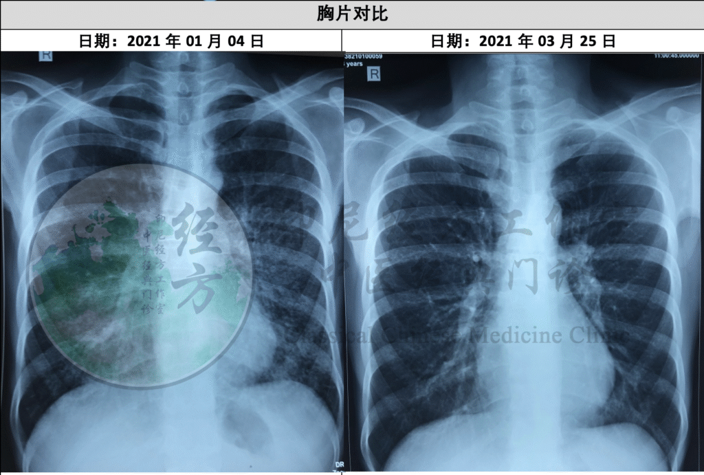 Perbandingan X-ray paru yang menunjukkan penurunan infiltrasi dan peningkatan kondisi paru pasien.
